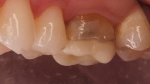 DOES MY PAIN STEM FROM MY CEREC CROWN?
