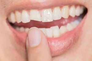 WHAT ACTIONS SHOULD I TAKE IF MY CEREC CROWN BREAKS?