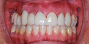 IS MY CEREC CROWN RESPONSIBLE FOR MY SENSITIVITY?
