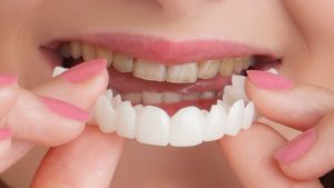 CAN A SNAP-ON SMILE BE USED WITH MISSING TEETH?